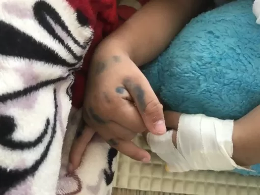 Cứu sống bệnh nhi mắc tay chân miệng nguy kịch