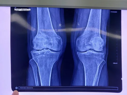 Nội soi lấy sỏi trong đầu gối bệnh nhân 71 tuổi