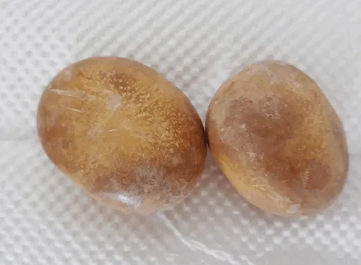 Lấy 2 viên sỏi to như trứng gà trong bàng quang cụ ông 83 tuổi