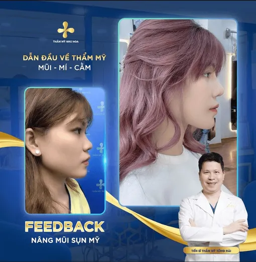 Nâng mũi sụn Mỹ có tốt không? Chi phí nâng mũi bao nhiêu