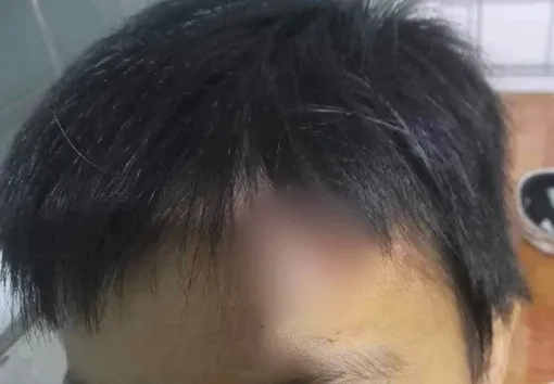 Cà Mau: Chỉ đạo làm rõ vụ “cháu bé từng bị hành hạ lại bị bầm mình, rách đầu”