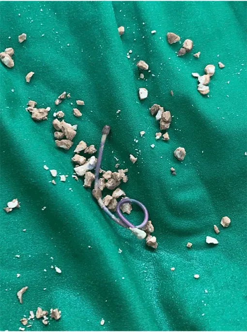 Lấy ống nhựa bị bỏ quên 5 năm trong bàng quang nữ bệnh nhân ở Cần Thơ