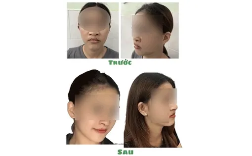 Phẫu thuật chỉnh hình mũi hở hàm ếch cho nữ bệnh nhân 17 tuổi