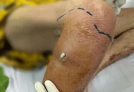 Cứu kịp cụ bà bị nhiễm trùng huyết nguy kịch từ vết xước nhỏ