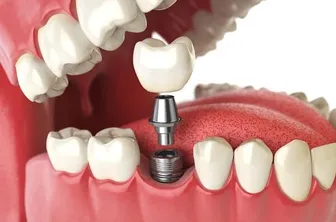 Khám Phá Cấy Răng Implant: Giải Pháp Hiện Đại Cho Răng Mất