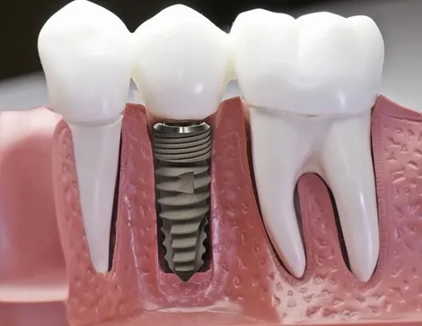 Công nghệ giúp trồng răng Implant không đau tại Nha khoa Quốc tế Phú Hòa