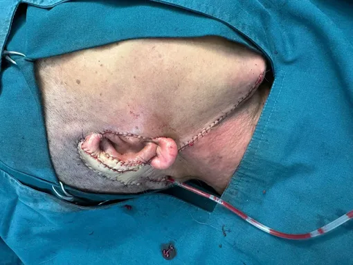 Phẫu thuật thành công ca ung thư da phức tạp Phẫu thuật thành công ca ung thư da phức tạp