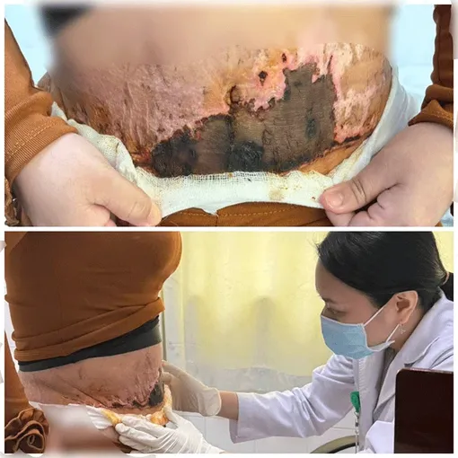 Bị biến chứng hoại tử sau hút mỡ bụng tại spa Bị biến chứng hoại tử sau hút mỡ bụng tại spa