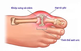 Điều trị bệnh gout theo Y học cổ truyền