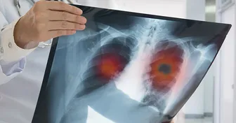 Ung thư phổi ở người không hút thuốc ngày càng tăng