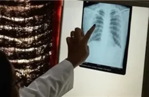 Tăng cường công tác phòng, chống bệnh lao