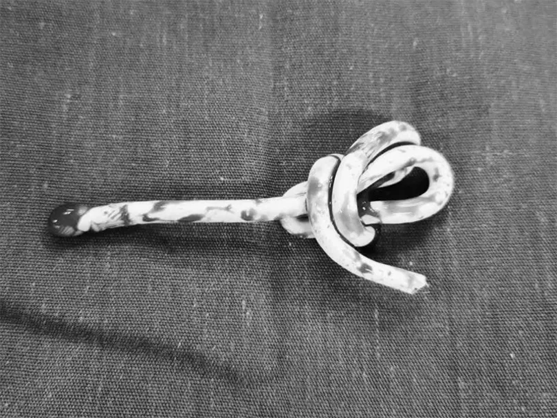 Thực hiện “thử thách” theo clip trên mạng xã hội, bệnh nhi 15 tuổi nhập viện mổ để lấy dị vật