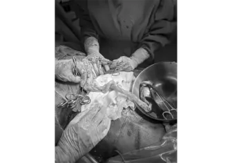 Bệnh viện Quân y 121 cứu sống thai nhi suy thai do biến chứng dây rốn thắt nút hiếm gặp