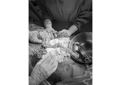 Bệnh viện Quân y 121 cứu sống thai nhi suy thai do biến chứng dây rốn thắt nút hiếm gặp