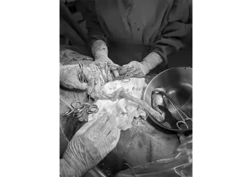 Bệnh viện Quân y 121 cứu sống thai nhi suy thai do biến chứng dây rốn thắt nút hiếm gặp