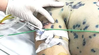 Thủy đậu ở người lớn: Nguy cơ biến chứng nặng, tử vong cao nếu chủ quan