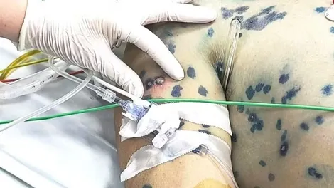 Thủy đậu ở người lớn: Nguy cơ biến chứng nặng, tử vong cao nếu chủ quan