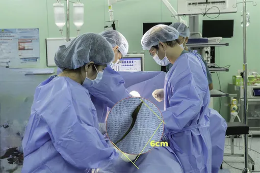 Can thiệp gắp xương cá dài 6cm đâm thủng ruột bệnh nhân