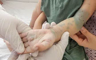 Cần cảnh giác cao độ với bệnh tay chân miệng