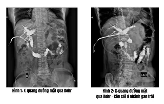 Sỏi ống mật chủ - Nguy hiểm âm thầm, điều trị hiệu quả nhờ kỹ thuật chuyên sâu