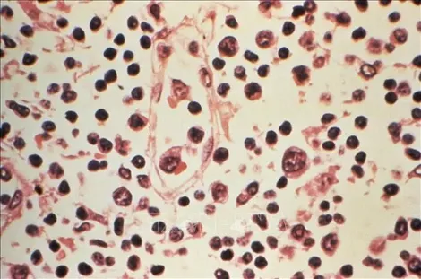 Argentina ghi nhận ca bệnh mắc virus Hanta tăng mạnh
