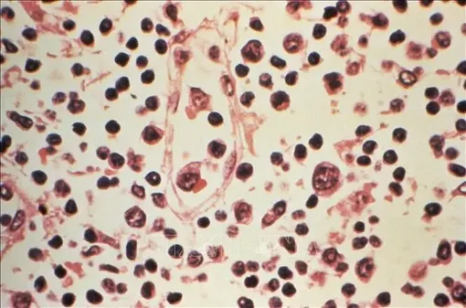 Argentina ghi nhận ca bệnh mắc virus Hanta tăng mạnh