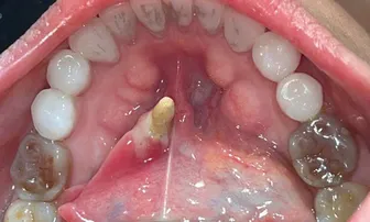 Phát hiện viên sỏi tuyến nước bọt dưới hàm “khổng lồ” hiếm gặp tại Bệnh viện Trường Đại học Y Dược Cần Thơ