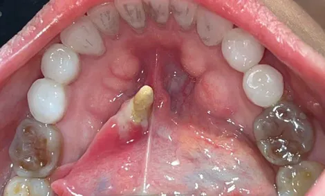 Phát hiện viên sỏi tuyến nước bọt dưới hàm “khổng lồ” hiếm gặp tại Bệnh viện Trường Đại học Y Dược Cần Thơ