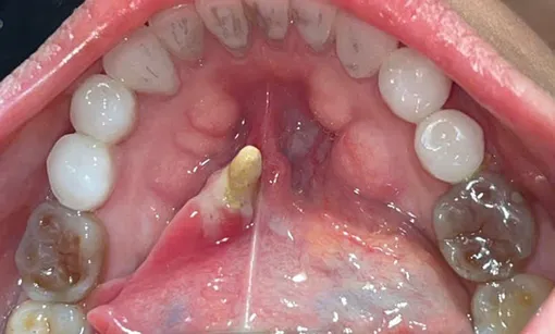 Phát hiện viên sỏi tuyến nước bọt dưới hàm “khổng lồ” hiếm gặp tại Bệnh viện Trường Đại học Y Dược Cần Thơ