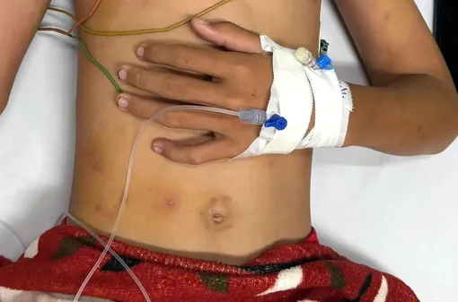 Cà Mau: Cứu sống bé trai bị ong vò vẽ đốt 55 vết