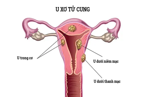 Phân loại theo FIGO u xơ tử cung: Chìa khóa cá thể hóa điều trị và bảo vệ sức khỏe sinh sản phụ nữ
