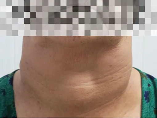 Phối hợp đa chuyên khoa trong xử trí bướu giáp khổng lồ tại Bệnh viện Trường Đại học Y Dược Cần Thơ