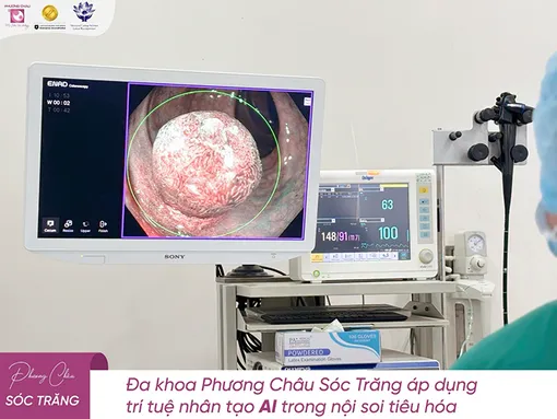 Nội soi lại sau 10 năm, bệnh nhân 65 tuổi phát hiện gần 20 polyp tiêu hóa