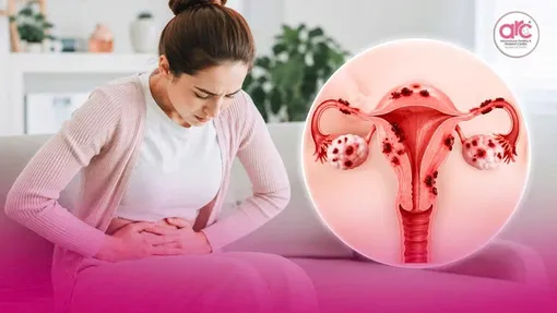 Lạc nội mạc tử cung có liên quan đến sức khỏe tâm thần