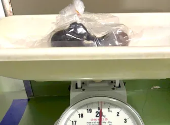 Cà Mau: Khối tóc 0,25kg trong đường tiêu hóa bé gái 5 tuổi