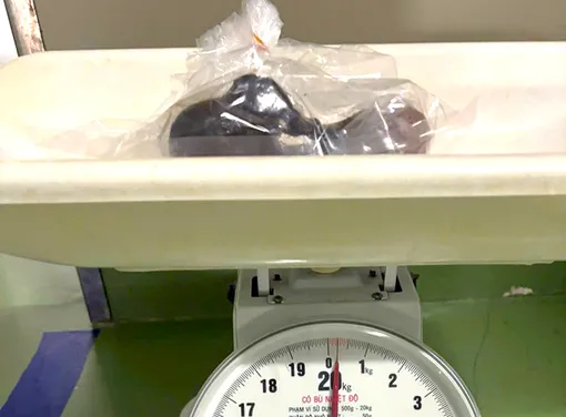 Cà Mau: Khối tóc 0,25kg trong đường tiêu hóa bé gái 5 tuổi