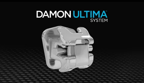 Damon Ultima: Bước tiến mới trong kiểm soát chuyển động răng
